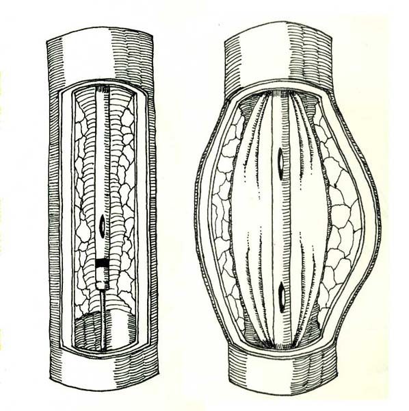 Medical Illustration of a Stint